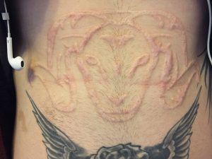 healed scarification after 9-10 months